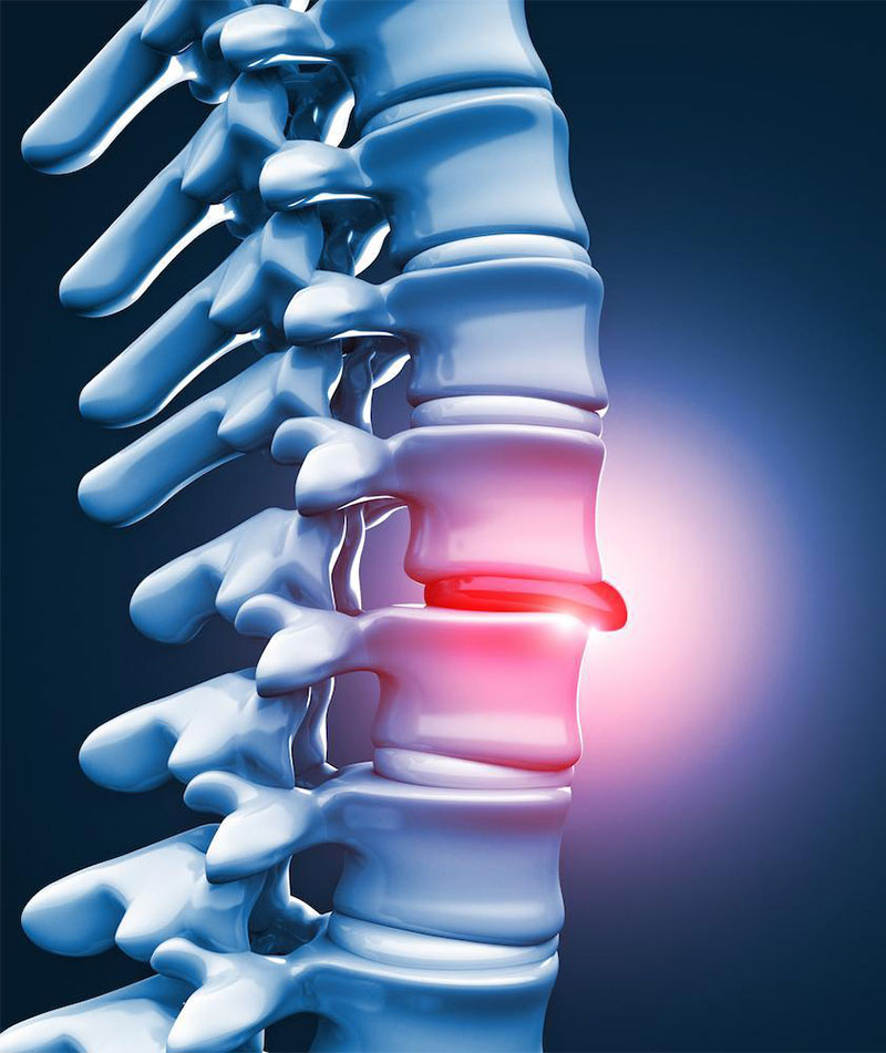 Causes and Risk Factors for Disc Issues