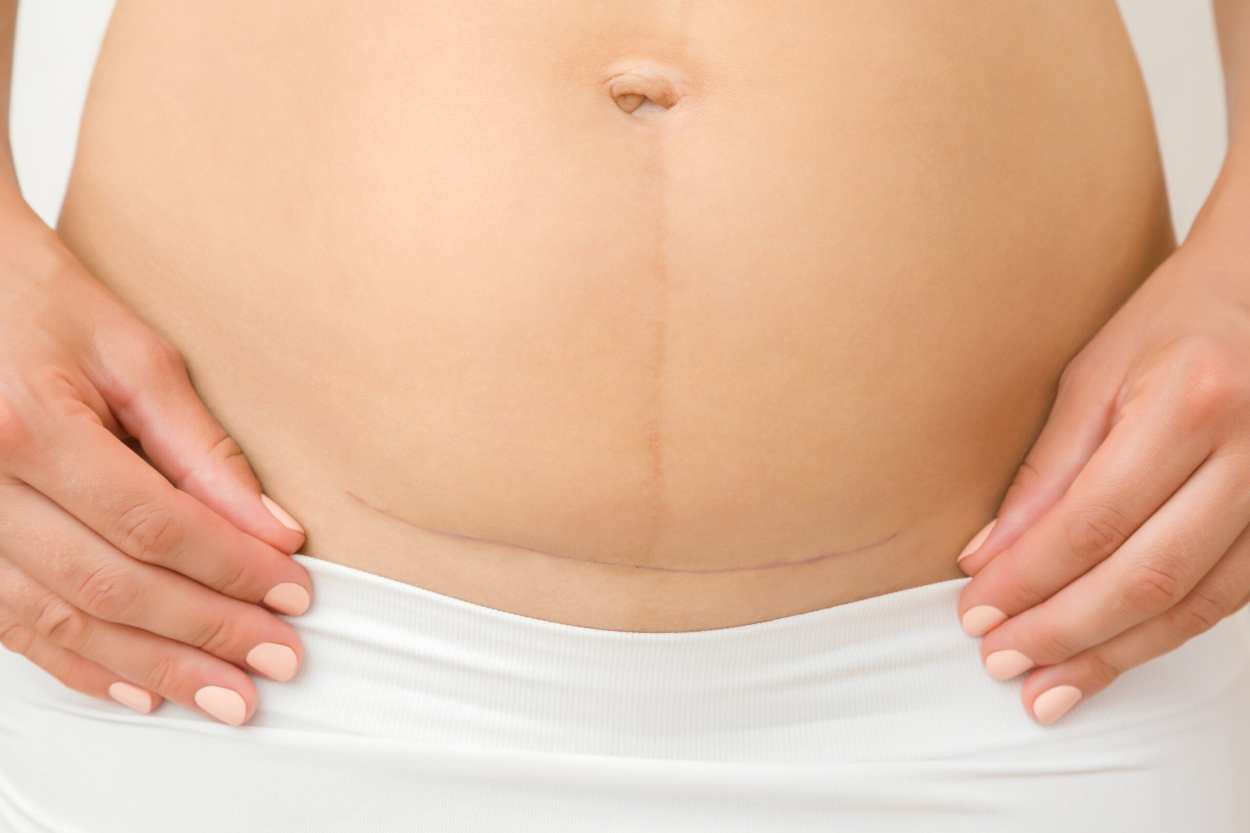 Woman,Naked,Belly.,Caesarean,Scar,After,Surgery,Because,Of,Baby Chronic Pain Treatment at Active Chiropractic at Royersford, PA